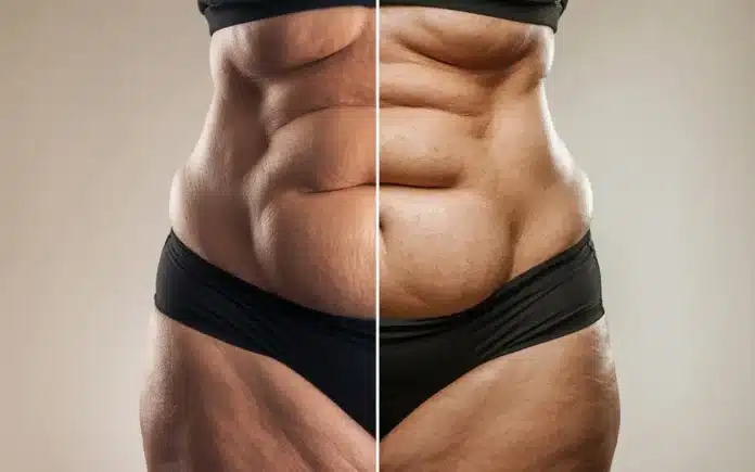 Apron belly before and after weight loss featured image showing transformation