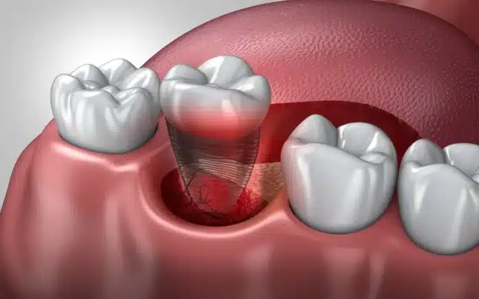 what does a healthy tooth extraction look like