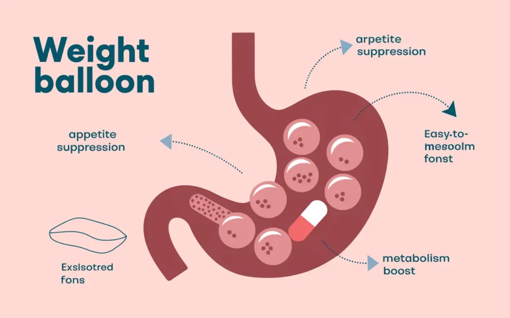 Diagram showing how weight loss balloon pills work in the stomach